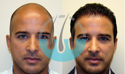 hair transplantation bodrum