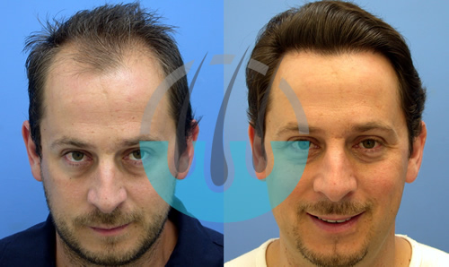 Hair Transplant Bodrum Package – Professional Hair Transplant in Bodrum Turkey