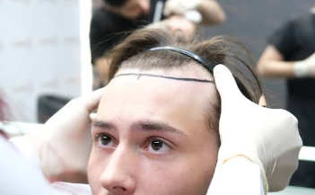 Natural Hairline Design in Bodrum