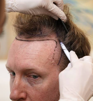Natural Hairline Design in Bodrum